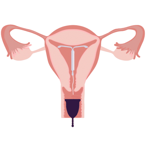 Coupe menstruelle et stérilet : peut-on utiliser une cup si on ...