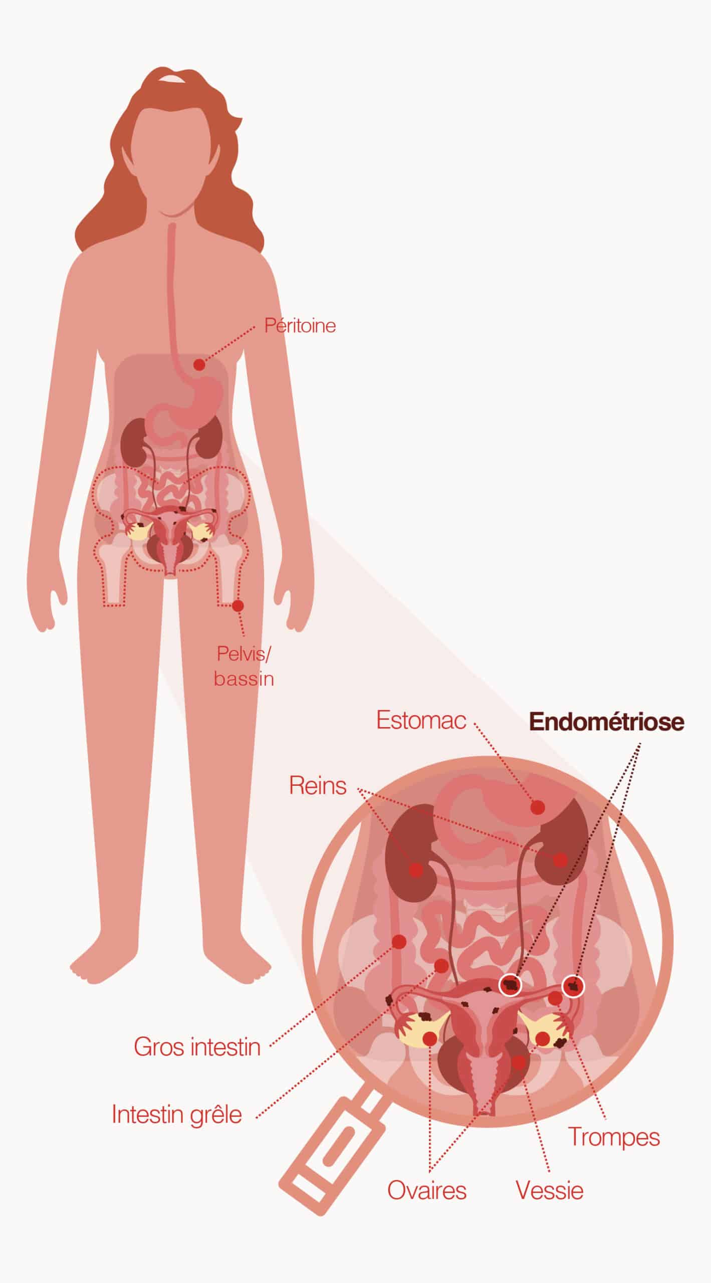 Blog_maptho_claripharm_schema_endometriose